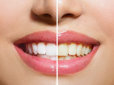 teeth whitening
